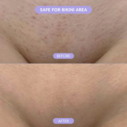 Smoothé — Body Hair Removal Spray